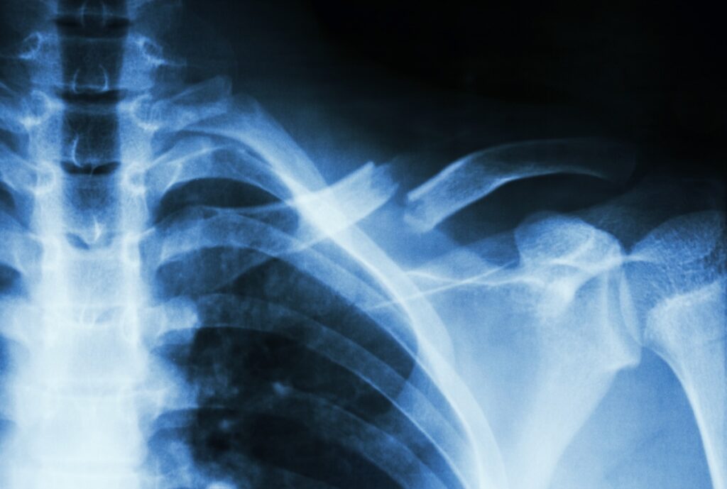 Surgical Management of Clavicle Fracture
